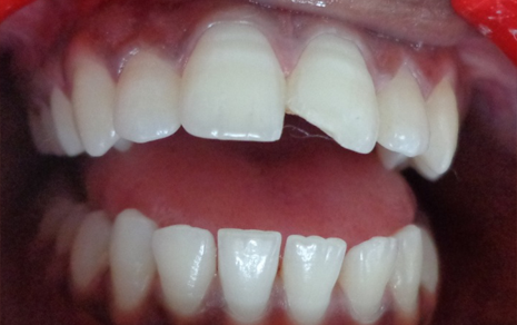Dental Filling
